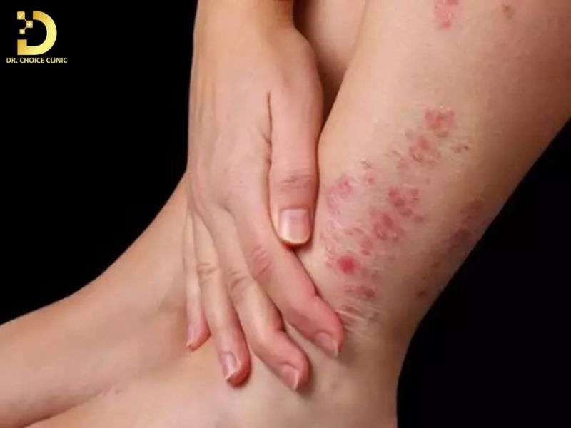 Người bị viêm da cơ địa nên bôi thuốc gì để kiểm soát triệu chứng an toàn?