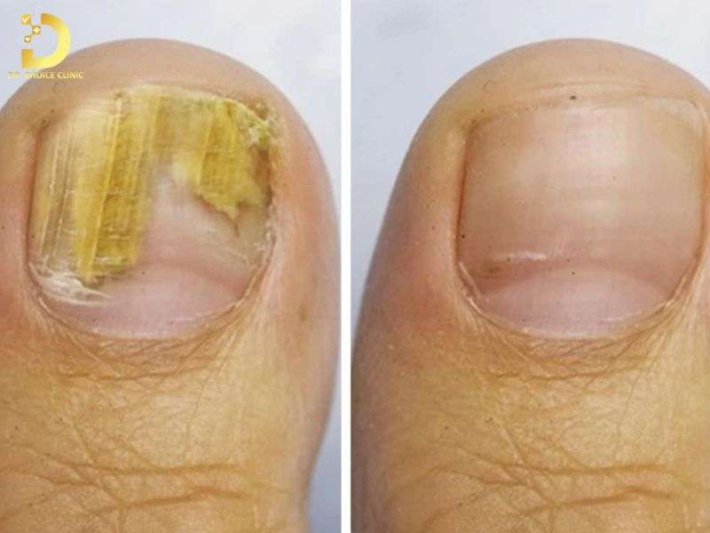 Nấm Móng: Triệu Chứng, Nguyên Nhân & Cách Điều Trị Hiệu Quả 10 Những nguyên tắc vàng để phòng ngừa tái phát nấm móng