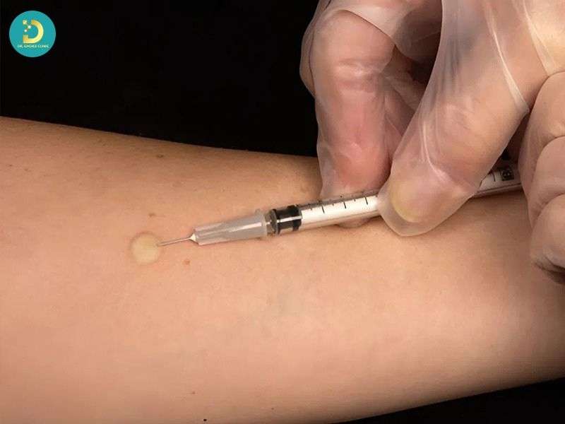 Những sai lầm cần tránh khiến sẹo nặng hơn