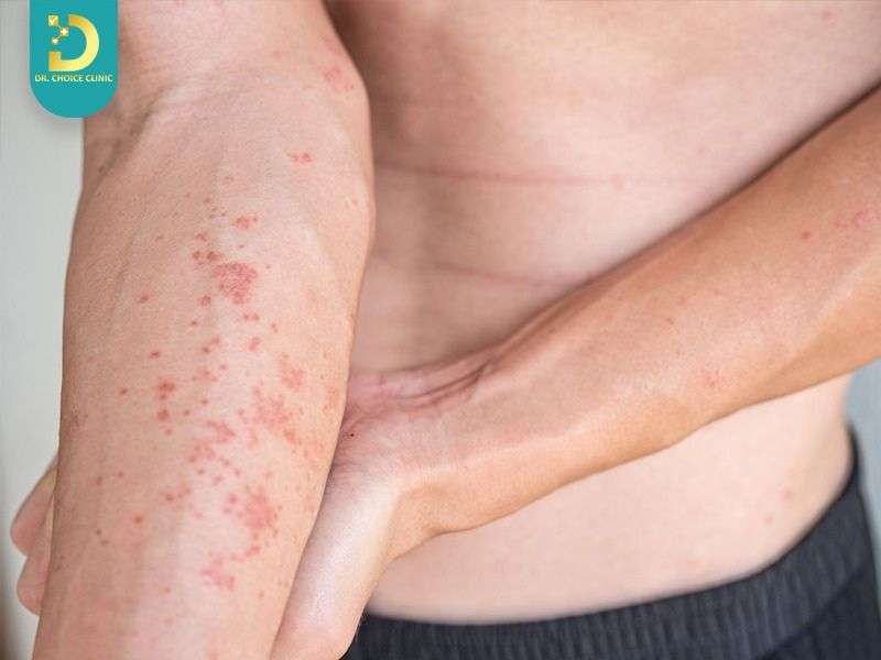 Viêm Da Tiếp Xúc Có Tự Khỏi Không? Cách Điều Trị Tại Nhà Hiệu Quả 21 Những sai lầm phổ biến khiến viêm da tiếp xúc kéo dài