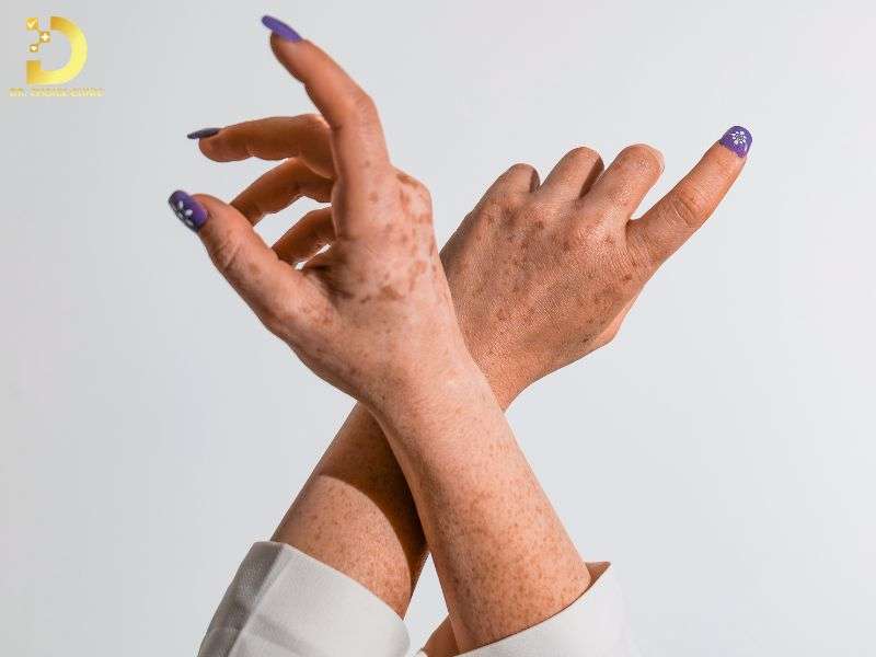 Những sai lầm phổ biến nào người bị viêm da cần tránh?