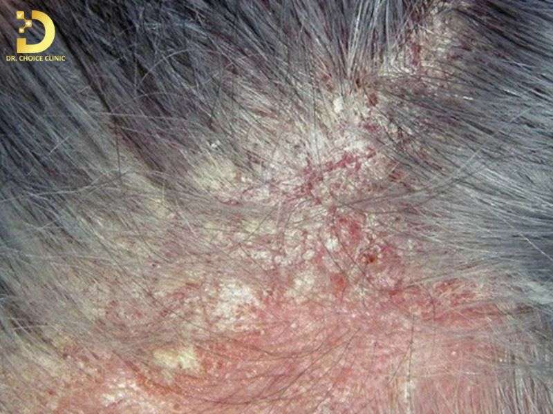 Nấm Da Đầu: Nguyên Nhân, Triệu Chứng & Cách Điều Trị Hiệu Quả 7 Những thói quen và yếu tố môi trường nào làm tăng nguy cơ lây nhiễm?