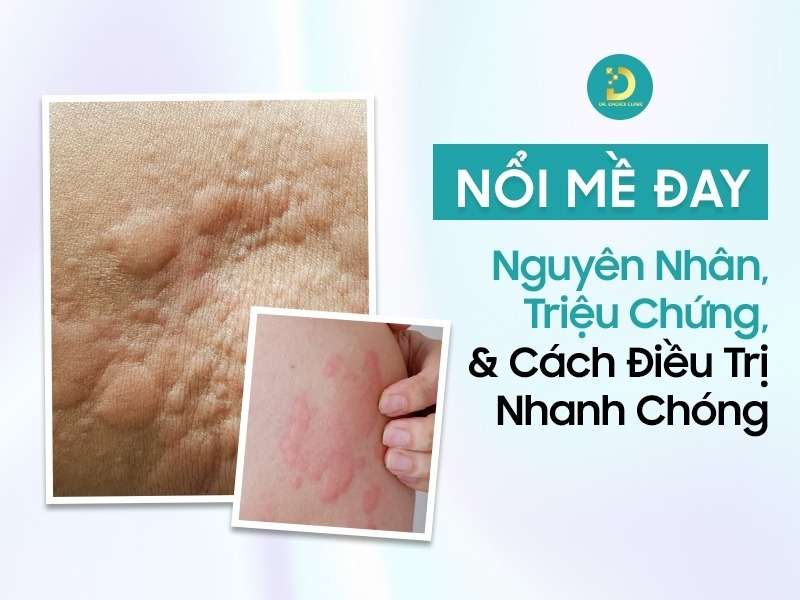 Nổi mề đay