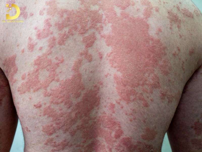 Quy trình điều trị viêm da chuẩn y khoa bao gồm những bước nào?