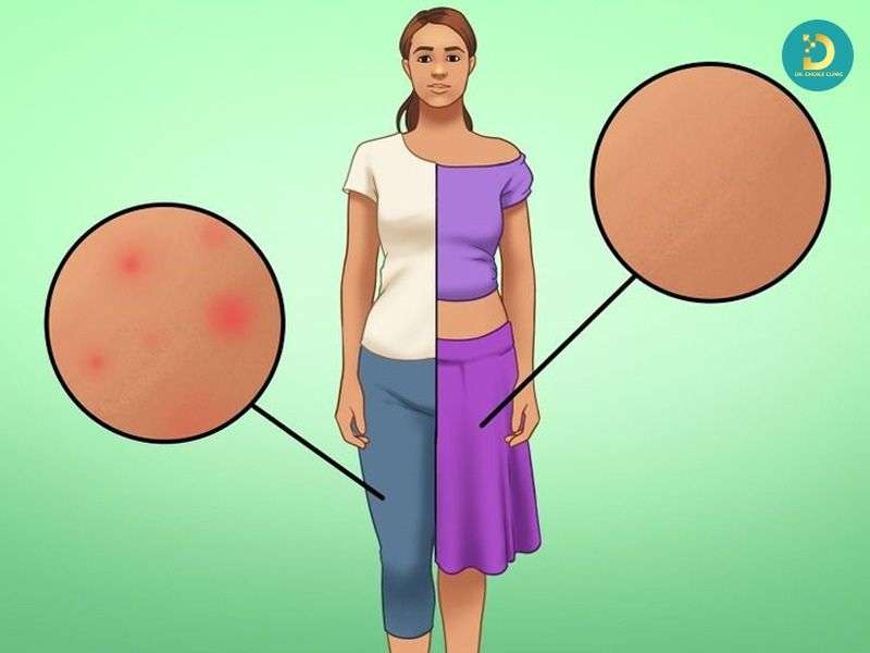 Sai lầm khiến mề đay kéo dài hoặc trở nên nặng hơn