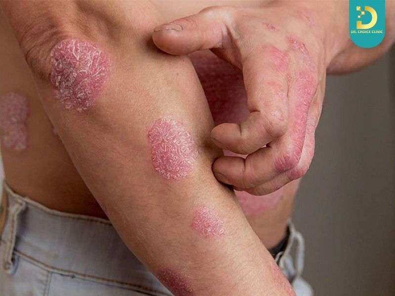 Sai lầm thường gặp khi tự điều trị vảy nến tại nhà