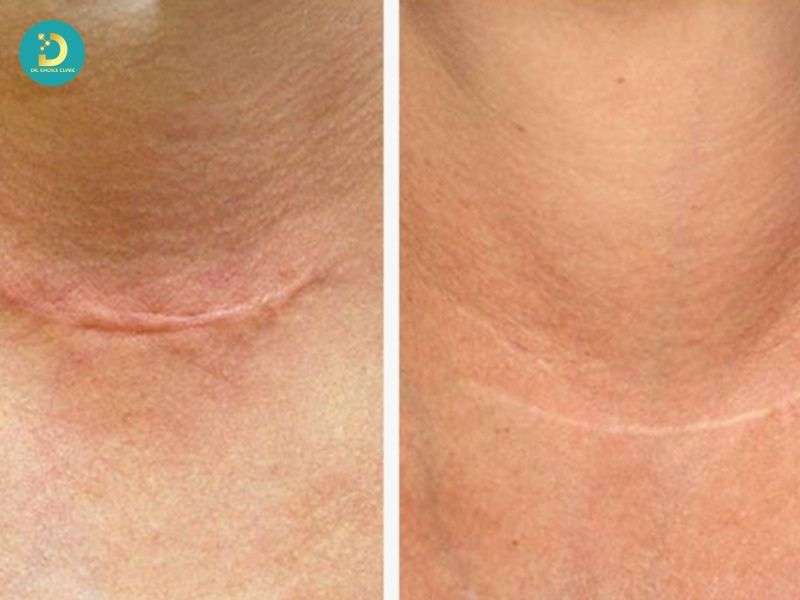 Sản Phẩm Trị Sẹo Lồi: Công Dụng, Hiệu Quả, Các Loại, Có Nên Dùng? 13 Sản phẩm trị sẹo lồi có thể cải thiện những vấn đề gì?