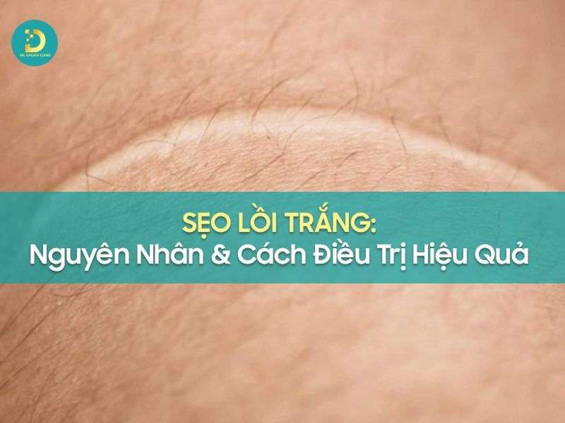 Sẹo lồi trắng
