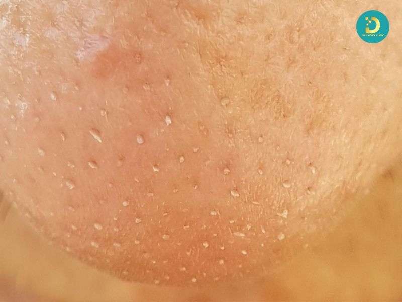 Mụn Đầu Đen & Sợi Bã Nhờn: Phân Biệt Để Điều Trị Hiệu Quả 15 Sợi bã nhờn là gì?