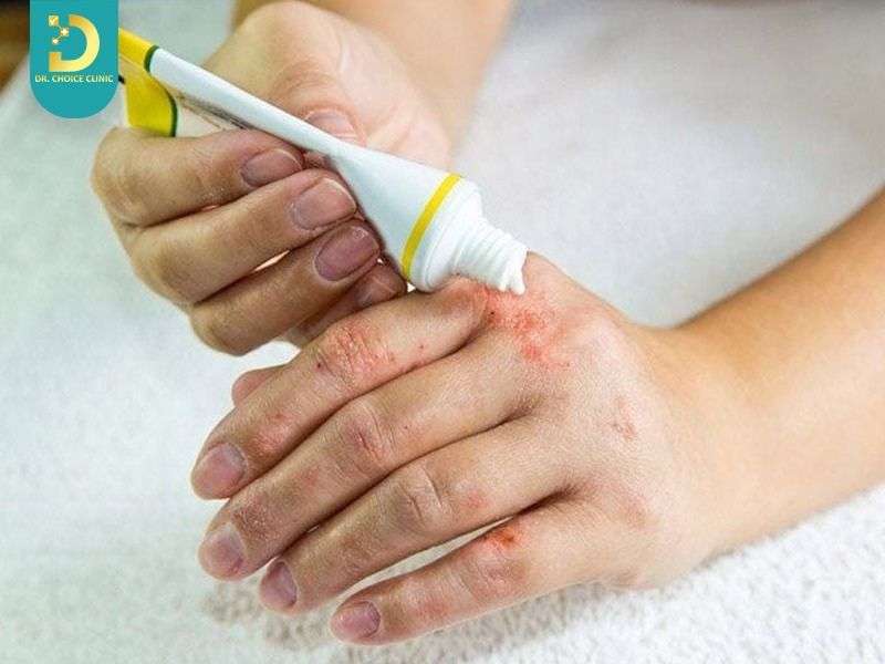 Viêm Da Tiếp Xúc Có Tự Khỏi Không? Cách Điều Trị Tại Nhà Hiệu Quả 17 Sử dụng thuốc bôi – thuốc uống khi cần thiết