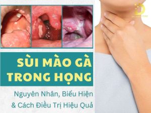 Sùi mào gà trong họng