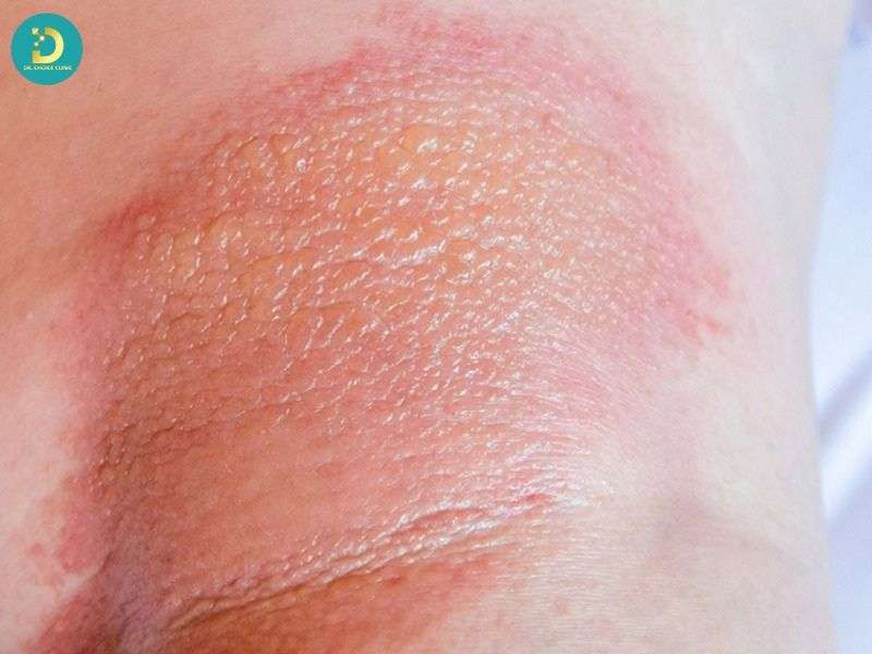 Triệu chứng theo từng mức độ