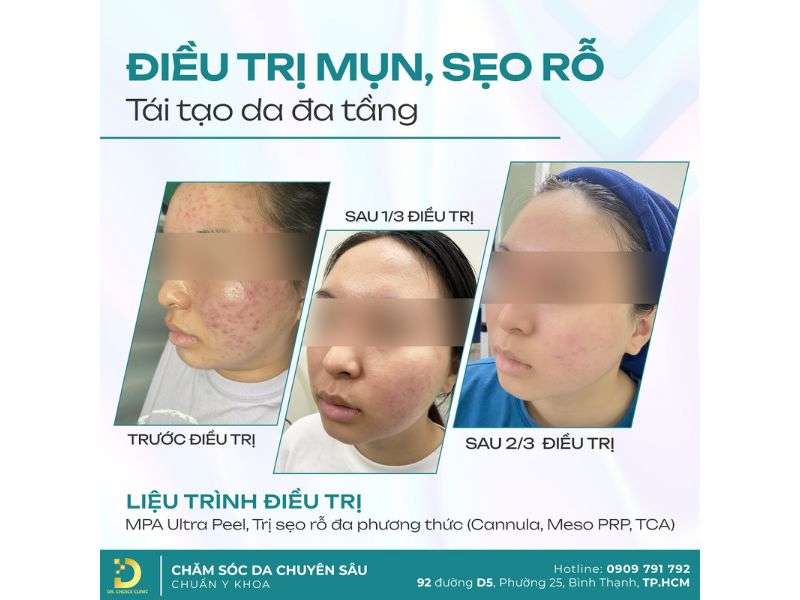 Mụn Đầu Đen & Sợi Bã Nhờn: Phân Biệt Để Điều Trị Hiệu Quả 22 Địa chỉ nào điều trị mụn đầu đen an toàn, hiệu quả HCM?