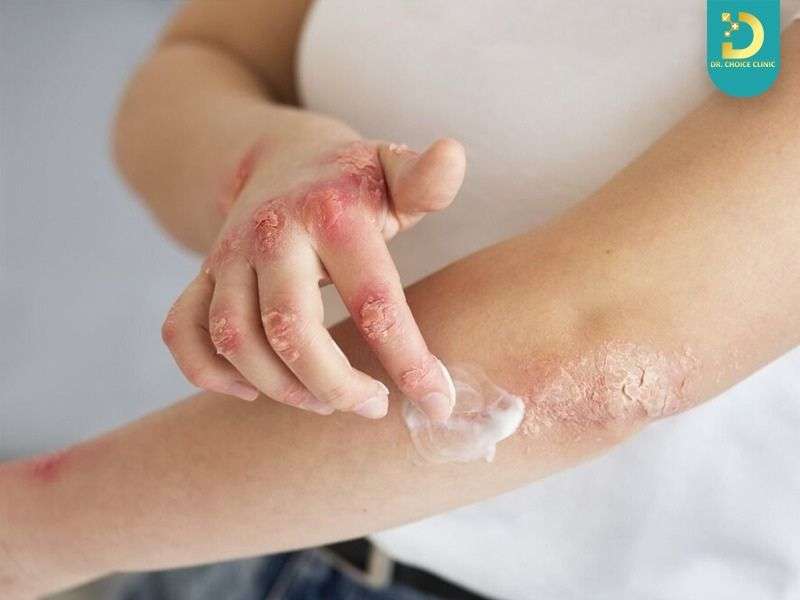 Vảy nến bôi gì để giảm viêm và bong tróc?