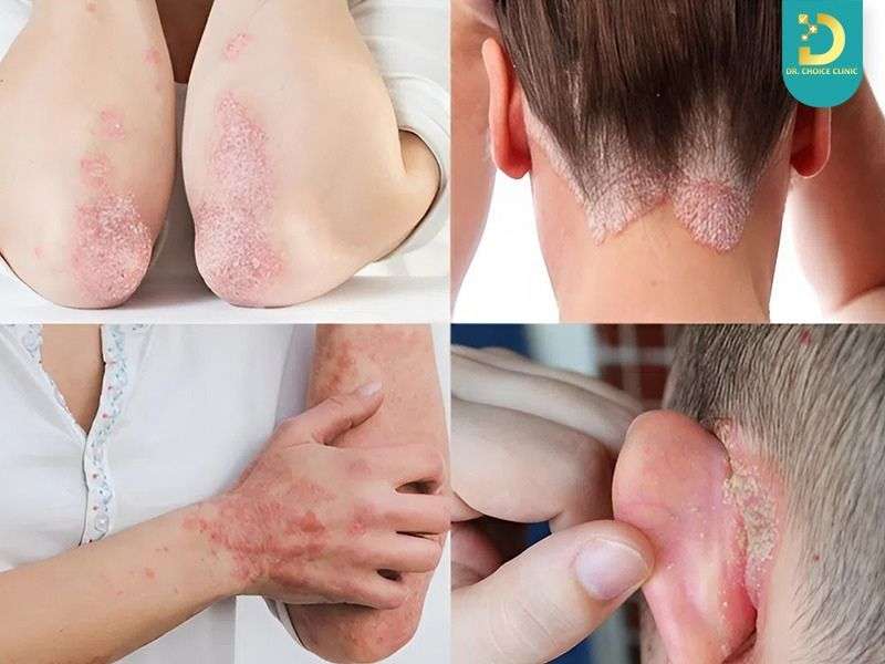 Vảy nến có hết không?