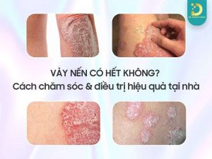 Vảy nến có hết không?