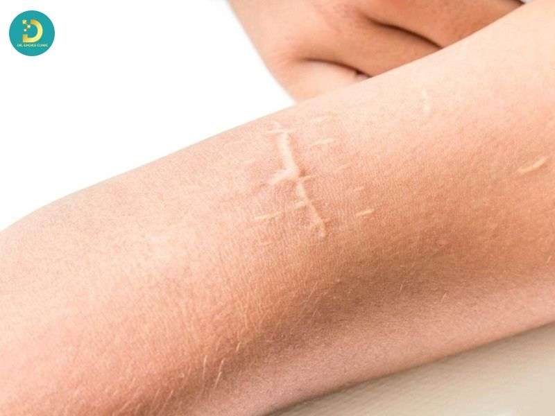 Vì sao sẹo lồi trắng khó điều trị hơn sẹo lồi đỏ?