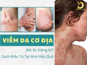 Viêm da cơ địa bôi gì, kiêng gì?
