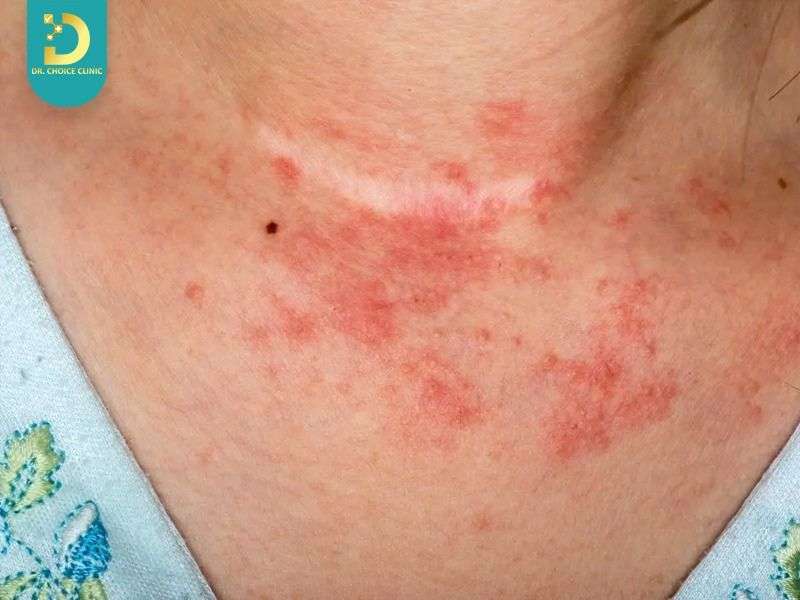 Viêm Da Tiếp Xúc Có Tự Khỏi Không? Cách Điều Trị Tại Nhà Hiệu Quả 15 Viêm da tiếp xúc có tự khỏi không?