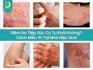 Viêm da tiếp xúc có tự khỏi không?