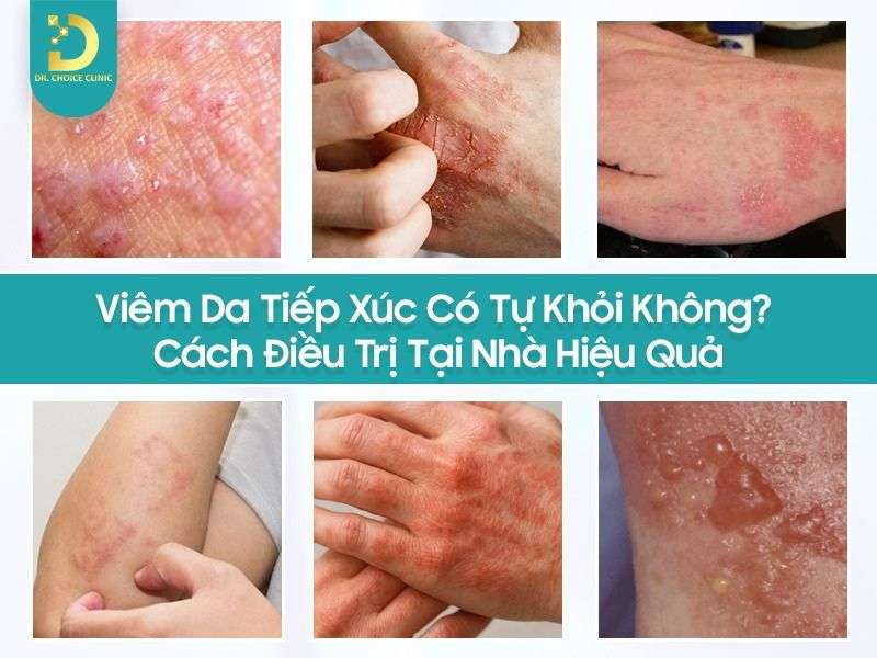 Viêm Da Tiếp Xúc Có Tự Khỏi Không? Cách Điều Trị Tại Nhà Hiệu Quả 13 Viêm da tiếp xúc có tự khỏi không?