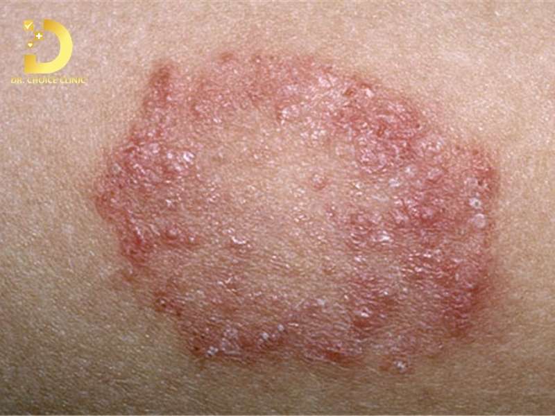 Bệnh nấm thân mình là gì? làm thế nào để nhận biết chính xác?