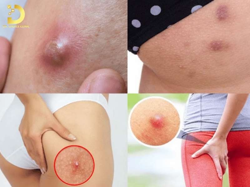 Nhọt và áp xe vùng mông 