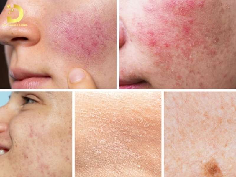 Các dạng nấm da mặt thường gặp và cách nhận biết