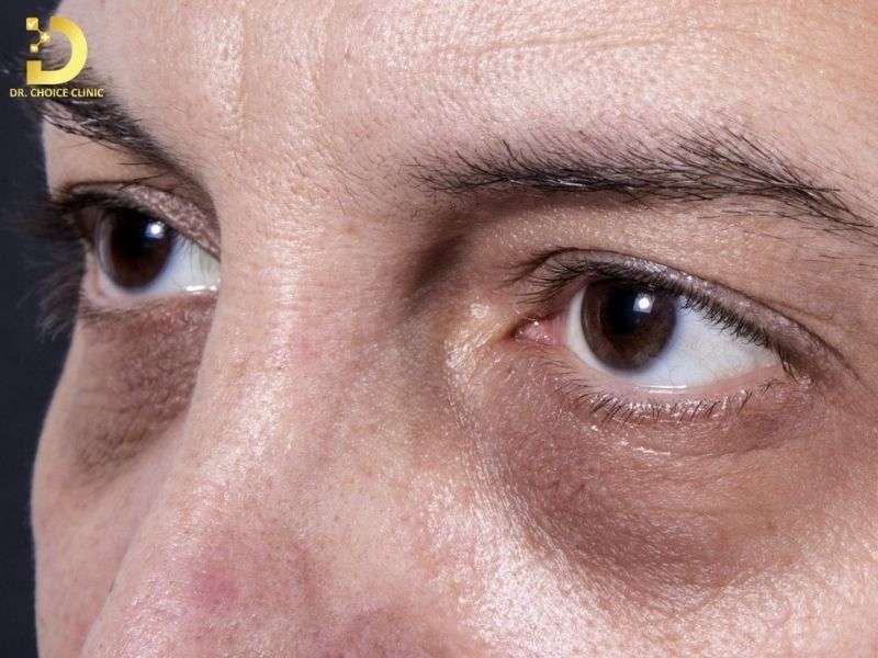 Thâm Mắt Do Đâu? Các Loại Thâm Mắt & Cách Điều Trị Hiệu Quả Tại Nhà 10 Các loại thâm mắt phổ biến và cách nhận biết