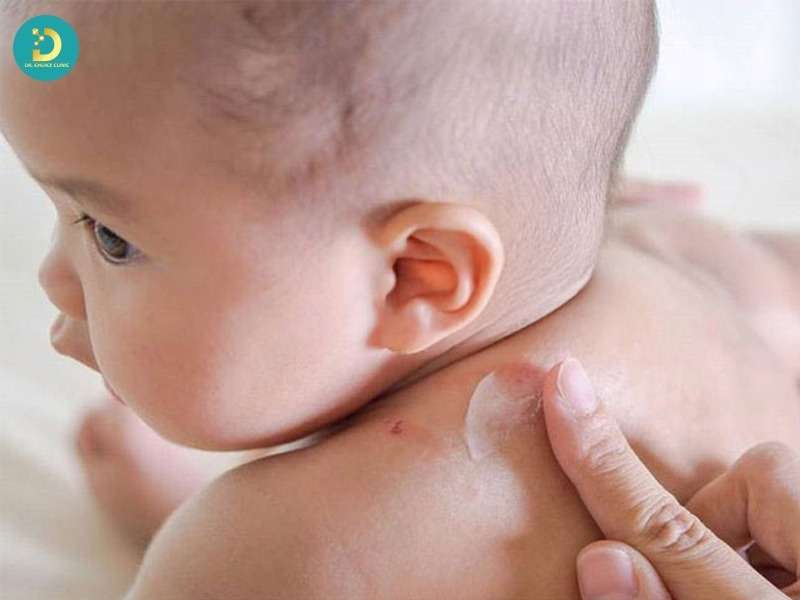 Sùi Mào Gà Trẻ Em: Nguyên Nhân, Dấu Hiệu, Cách Điều Trị & Phòng Ngừa 13 Các phương pháp điều trị sùi mào gà ở trẻ em an toàn hiện nay