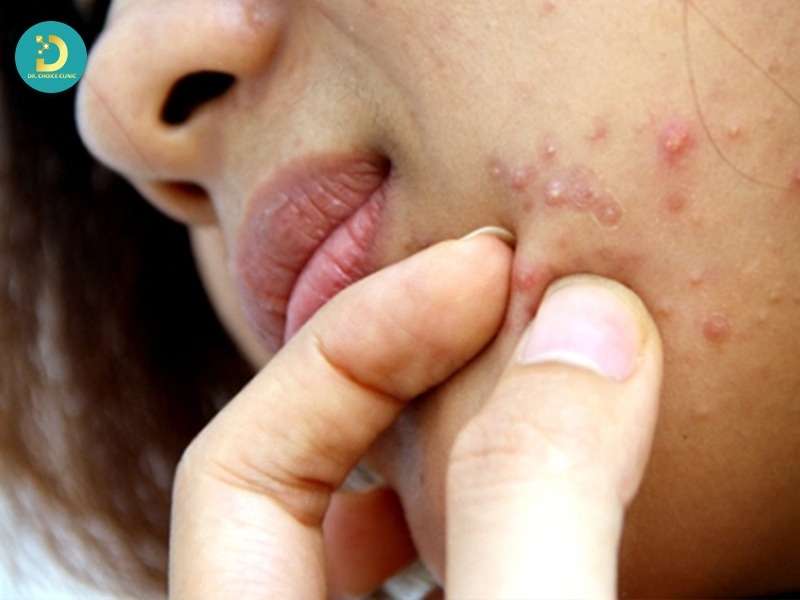 Các yếu tố làm mụn nặng hơn và kéo dài bệnh