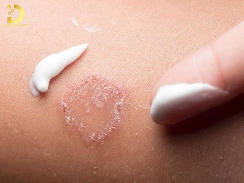 Cách điều trị nấm da mặt hiệu quả