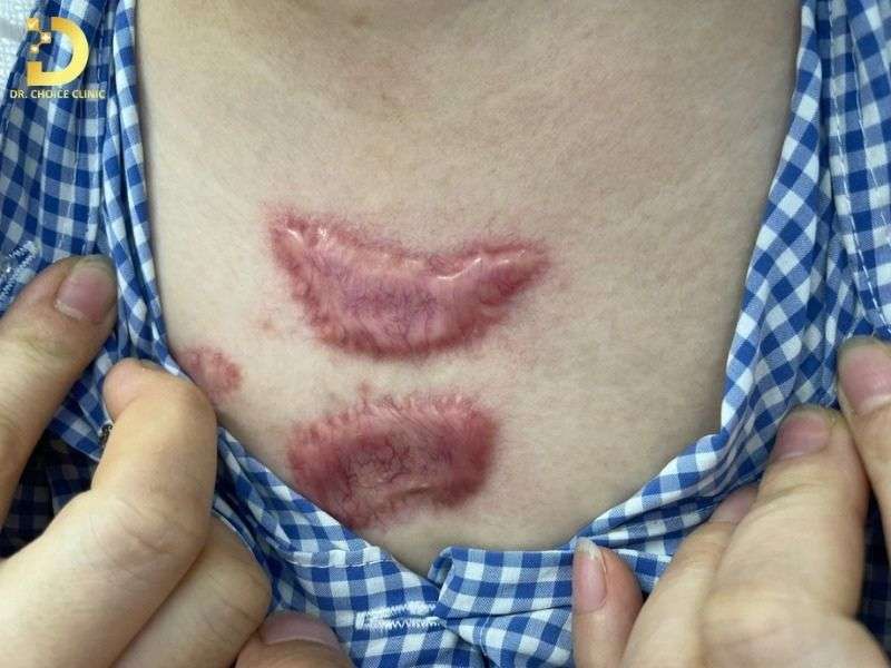 Sẹo Lồi Ở Ngực: Nguyên Nhân & Cách Điều Trị Hiệu Quả 9 Nhận biết sẹo lồi ở ngực – khi nào cần can thiệp sớm?