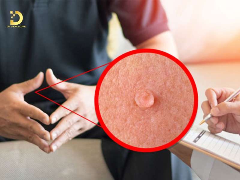 Sùi Mào Gà Có Hết Không? Cách Chữa Sùi Mào Gà Hiệu Quả 14 Chăm sóc điều trị sùi mào gà như thế nào để phòng ngừa tái phát?