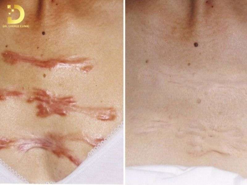 Sẹo Lồi Ở Ngực: Nguyên Nhân & Cách Điều Trị Hiệu Quả 11 Cách chăm sóc và phòng ngừa tái phát sau điều trị