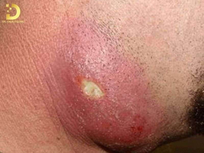 Có bao nhiêu loại mụn viêm thường gặp trên da?