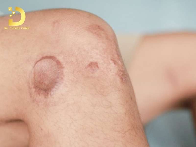 Cơ chế hình thành sẹo lồi ở vùng đầu gối như thế nào?