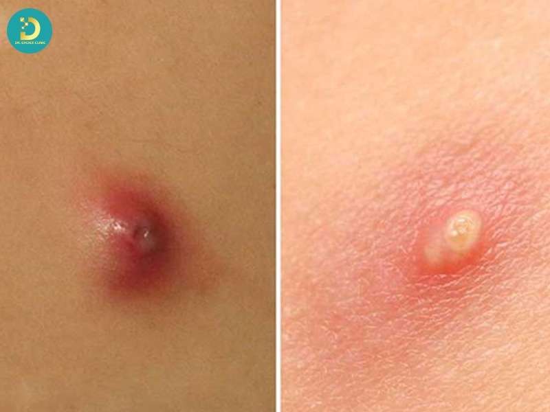 Cơ chế sinh học của mụn mủ