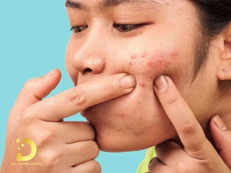 Có nên nặn mụn viêm đỏ không?