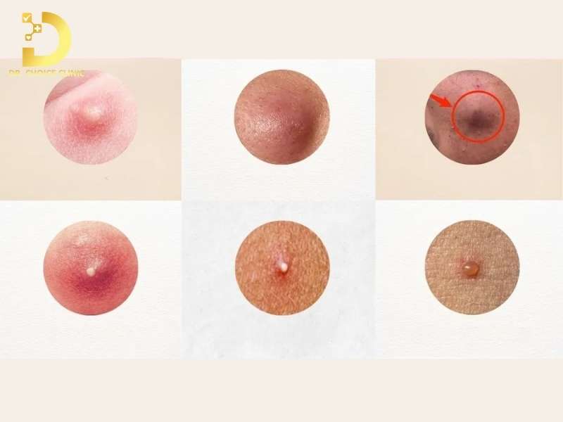 Có những dạng mụn bọc biến thể nào thường gặp trên thực tế?