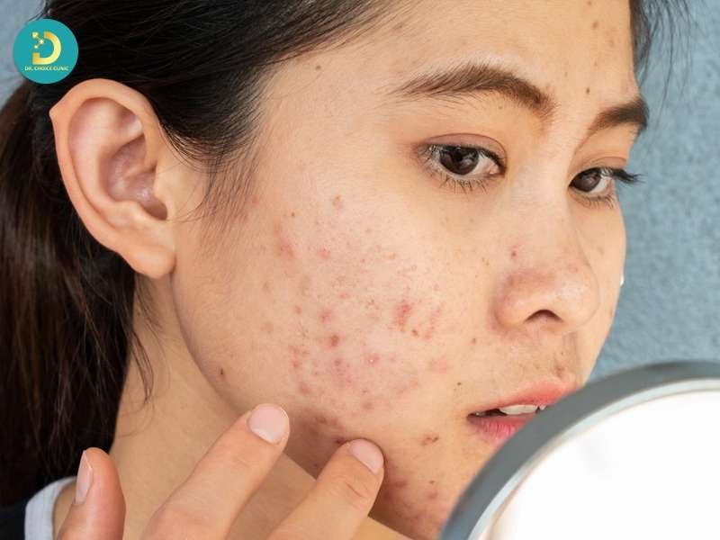 Đặc điểm và phân loại mụn ở tuổi dậy thì