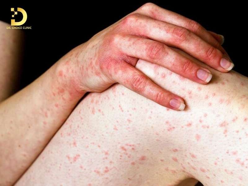 Dấu hiệu nhận biết viêm da kích ứng và phân biệt với các bệnh da liễu khác là gì?