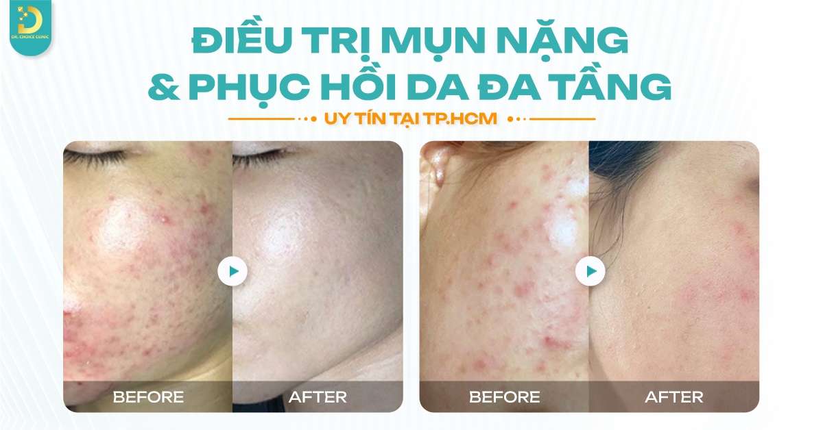 Địa chỉ nào điều trị mụn tuổi dậy thì an toàn, hiệu quả tại HCM?