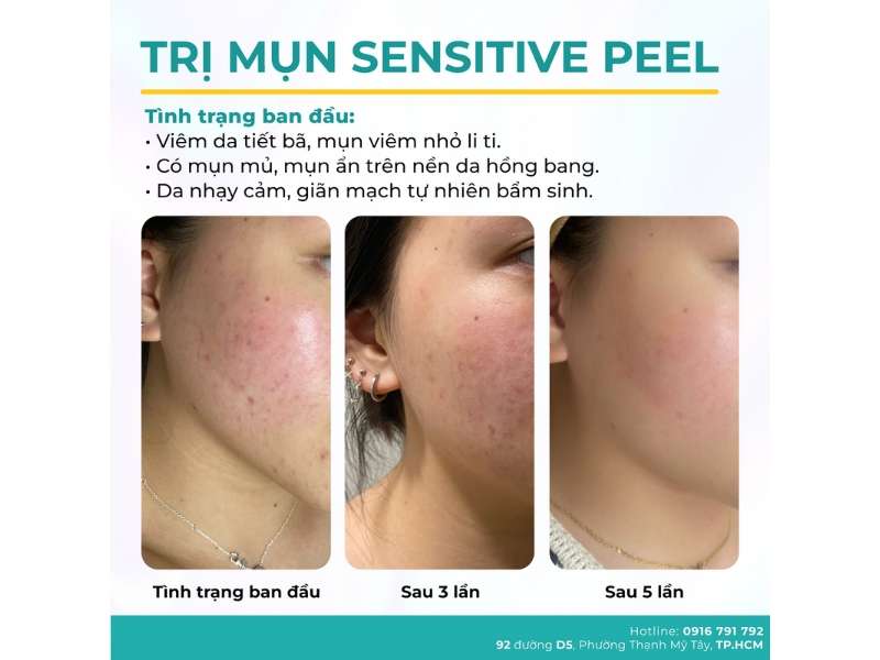 Địa chỉ nào điều trị mụn uy tín, chất lượng HCM?