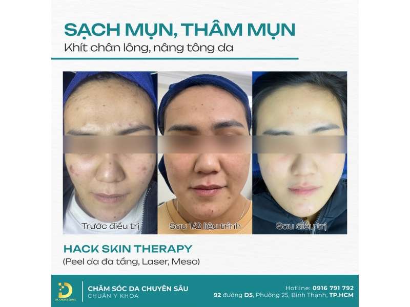 Địa chỉ nào điều trị mụn uy tín, chất lượng tại HCM?