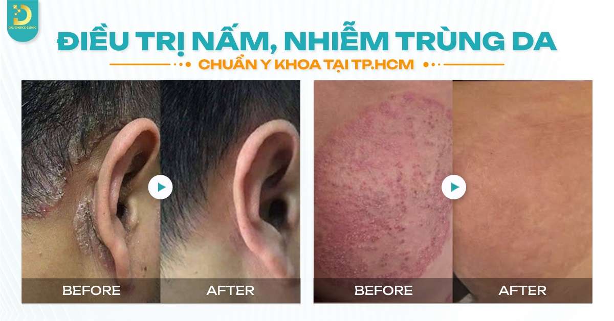 Điều trị nấm da mặt ở đâu an toàn, hiệu quả tại HCM?