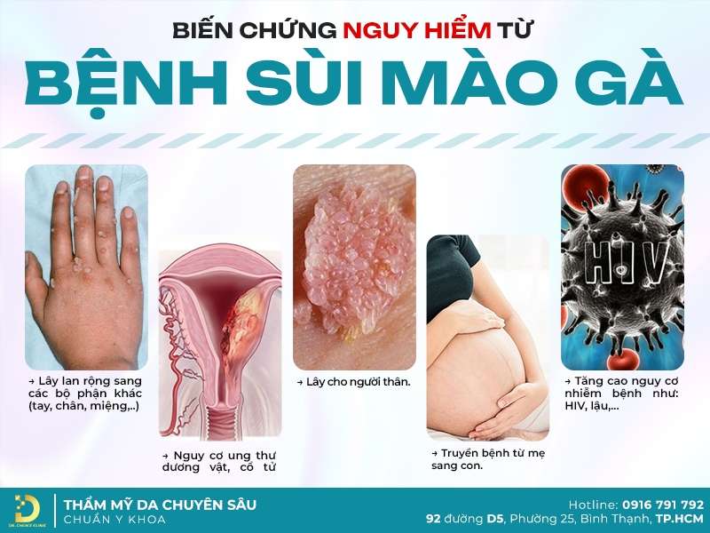 Sùi Mào Gà Có Hết Không? Cách Chữa Sùi Mào Gà Hiệu Quả 15 Điều trị sùi mào gà ở đâu uy tín và bảo mật thông tin?