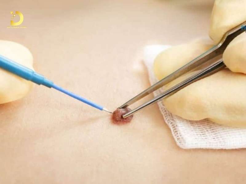 Sùi Mào Gà Có Hết Không? Cách Chữa Sùi Mào Gà Hiệu Quả 11 Đốt điện cao tần