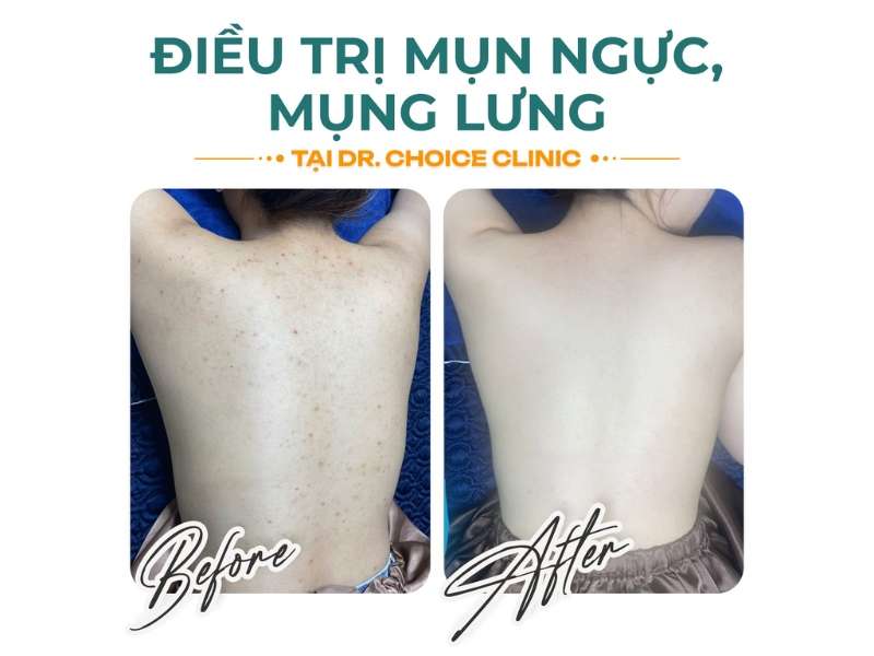Địa chỉ nào thăm khám, điều trị mụn uy tín, chất lượng?