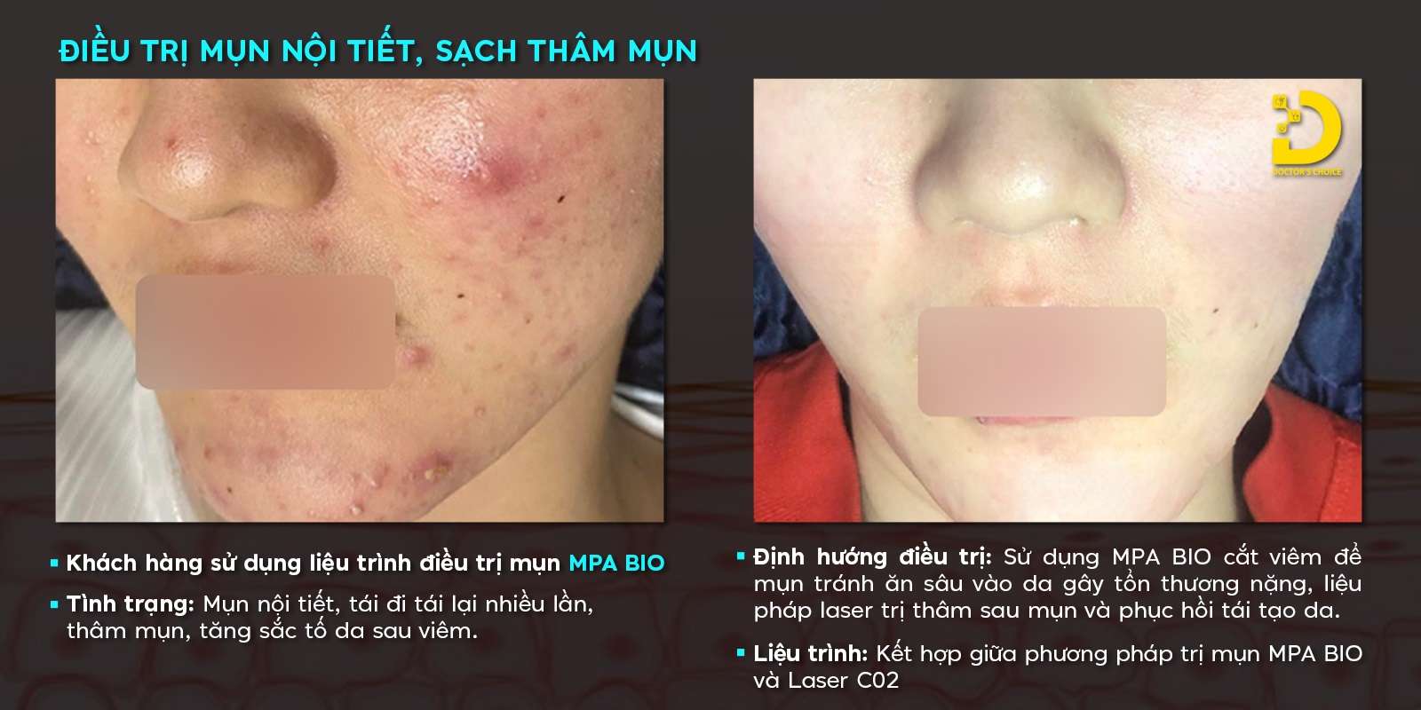 Dr. Choice Clinic trị mụn nội tiết và sách tham mun